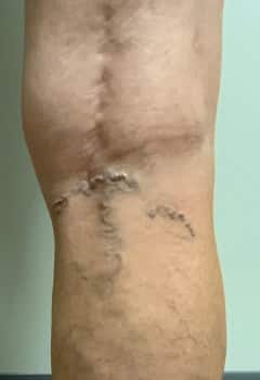 Ultrasound-Guided Sclerotherapy