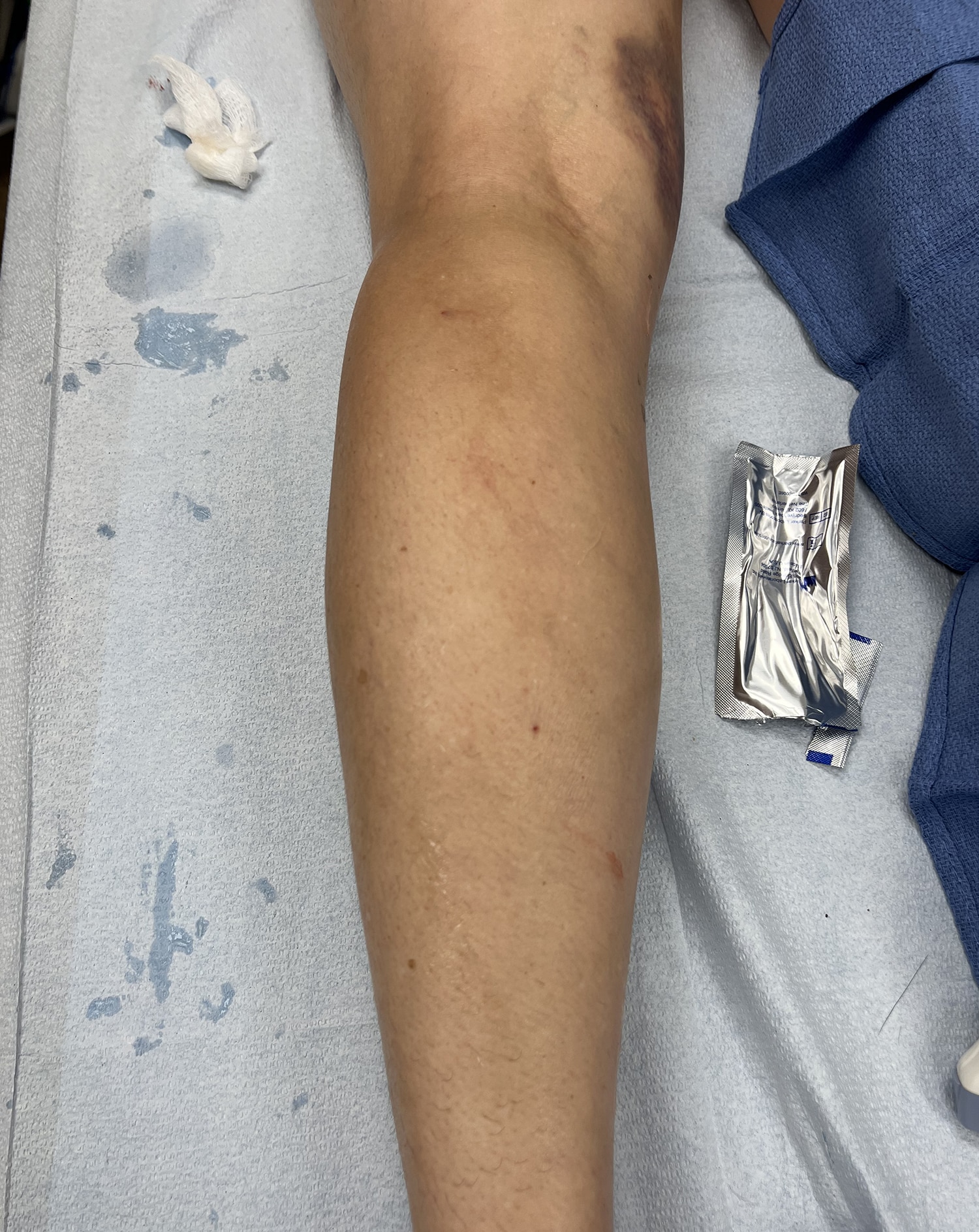 After Image: Radiofrequency Ablation - front