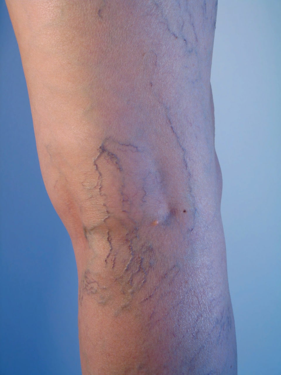 vein 8